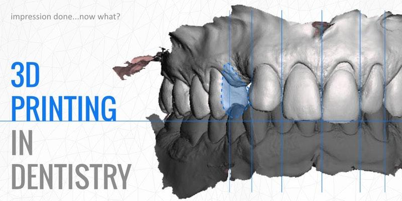 3D Printing In Dentistry